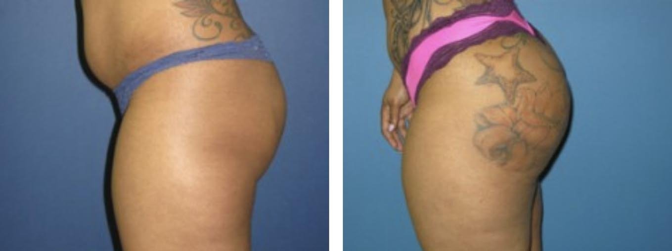 Buttock Augmentation NJ - Buttocks Augmentation New Jersey