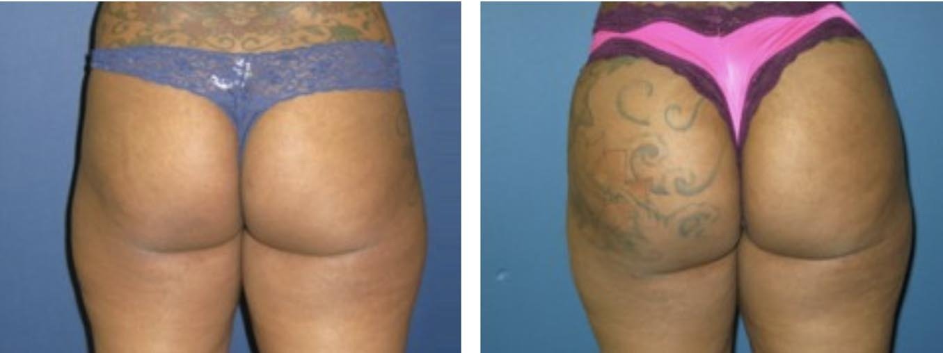 Large Volume BBL Fat Transfer and Body Contouring, NJ