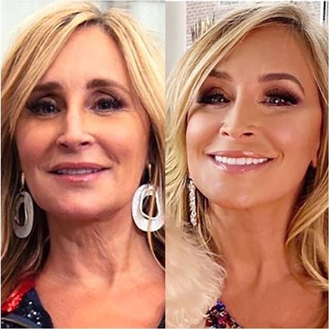 The Story Behind Sonja Morgan’s Deep Plane Facelift